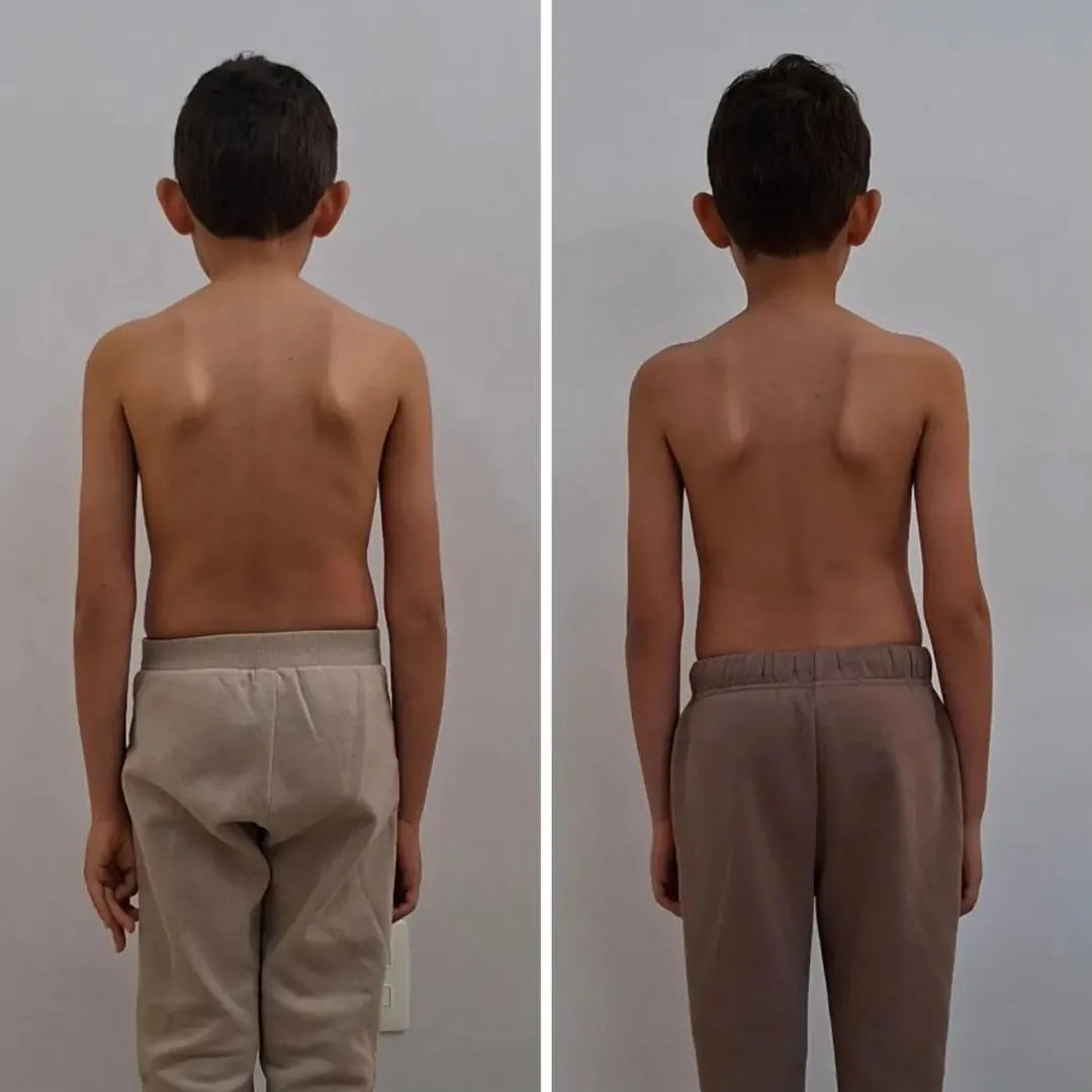 Duas fotos de um menino de costas, lado a lado, mostrando a evolução do padrão postural